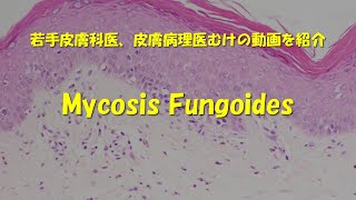 Mycosis fungoides解説動画 [upl. by Anma]