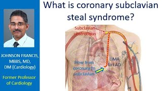 What is coronary subclavian steal syndrome [upl. by Celik276]