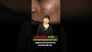 Acne Melasma Hyperpigmentation  How Skin Problems Can Lead to Depression Support amp Understanding [upl. by Zinah]