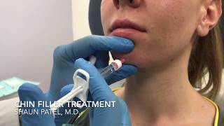 Chin augmentation with filler Restylane Lyft by Dr Shaun Patel [upl. by Idoux86]