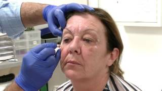 Injecting Botox into the Glabella region  Training Video For Medical Professionals Only [upl. by Haceber746]