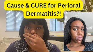 What causes PERIORAL Dermatitis And How to heal it Naturally [upl. by Ahsina]