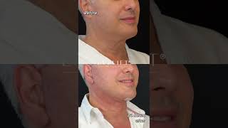 EVE Lift™ Patients Results  Eden Plastic Surgery Dr Ali Charafeddine MD [upl. by Aennyl]