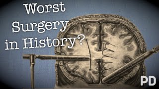 The Dark side of Science The Lobotomy the worst surgery in history Documentary [upl. by Beniamino]