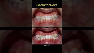 Braces process  Underbite [upl. by Kciredes]