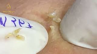 Loan Nguyen Acne Treatment 4774 [upl. by Aicaca873]