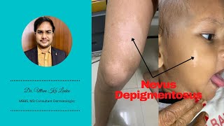 Nevus Depigmentosus  White birth mark and its treatment Skin me safed dag ka karan aur ilaz [upl. by Ylime467]