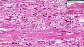 Histopathology Heart Myocardial infarction recent [upl. by Jsandye]