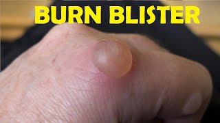 how to treat a burn blister on finger [upl. by Rafe]