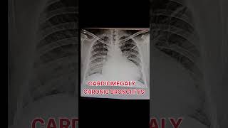 Cardiomegaly and chronic bronchitis shortvideo [upl. by Carnahan]