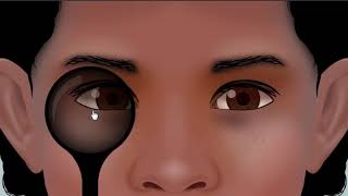 examination of esotropia  animation [upl. by Furnary514]