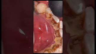 tooth scaling shorts viralvideo fyp [upl. by Della]