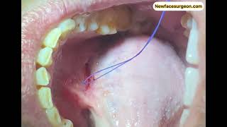 Salivary gland  Duct Stone Removal [upl. by Palua]