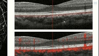 OCT Angiography Revolutionizing Vitreoretinal Disease [upl. by Vivian482]