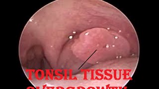 Tonsil tissue overgrowth Inflammatory Lymphoid tissue overgrowth [upl. by Vedetta]