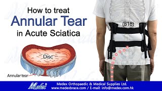 B18  How to treat Annular Tear in Acute Sciatica 3D Animation [upl. by Camella]