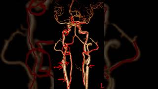 cerebral angiogram  session 4 [upl. by Karol]