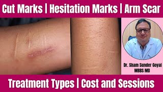 Cut Scar Marks  Hesitation Marks  Arm Scars  Treatment Types  Cost and Sessions [upl. by Tigirb795]