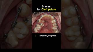 Braces for cleft palate progess braces orthodontist dentist dentistry [upl. by Ellertal]