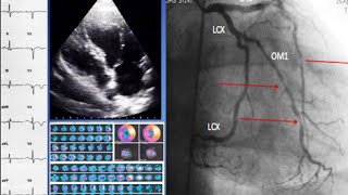 A case of ischemic cardiomyopathy ECG echo SPECT coronary angiography and treatment [upl. by Faria675]