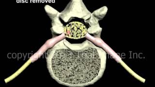 Lumbar Discectomy disc removal and Fusion  Narration and Animation by Cal Shipley MD [upl. by Ailaro]