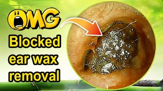 Is Hydrogen Peroxide Really Better Than Ear Drops for Ear Wax Removal [upl. by Malek549]