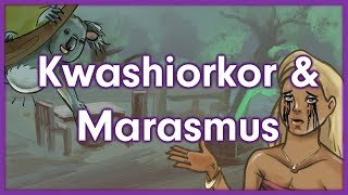 Kwashiorkor vs Marasmus  Nutrition Mnemonic [upl. by Jarek]