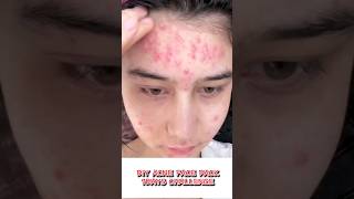 How To Remove Acne At Home Naturally ⁉️💯 shorts diy youtube [upl. by Nylassej]