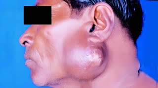 Tuberculous Abscess of Parotid Gland [upl. by Fisch]