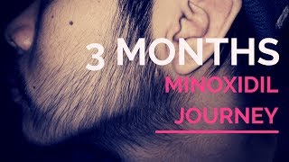 Week 12 Minoxidil Beard Journey [upl. by Yleoj]