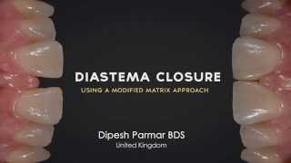 Diastema Closure Perfection  Using a modified matrix approach [upl. by Yves]