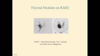 Thyroid Cancer  CRASH Medical Review Series [upl. by Rema]