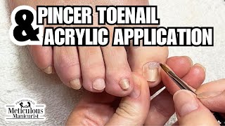 Fix for Yellow Toenails at Home nails satisfying [upl. by Bugbee]