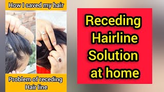 Receding hairline regrowth treatment at homeSide baldness cure [upl. by Namijneb]