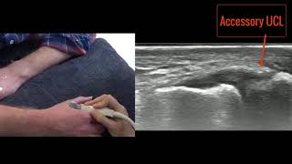 Ultrasound of the UCL of the thumb [upl. by Ahseikram]