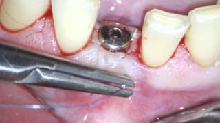 Implant uncovery and soft tissue augmentation [upl. by Judith]