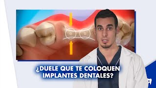 COLOCACIÓN de IMPLANTES dentales  ¿Es doloroso ¿Todo el mundo puede usarlos  Shorts [upl. by Irrak]