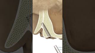 GDT MAX BasalCortical Dental Implant Drilling Protocol [upl. by Kenzi]