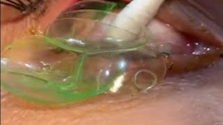 Doctor removes 23 contact lenses from patients eye [upl. by Coffee688]