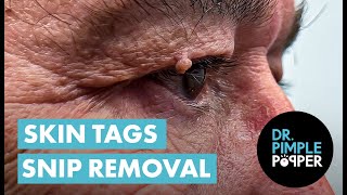 Acrochordon Snip Removal Dr Pimple Popper REMOVES Skin Tags Near Eyes [upl. by Ylle146]