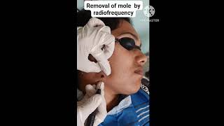 Removal of mole by radiofrequency I Skin Care [upl. by Norman59]