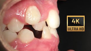 Class III and Crossbite stability after 8 years Braces time lapse [upl. by Ahcarb]