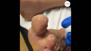 Tip of Big Toe Callus [upl. by Romito788]