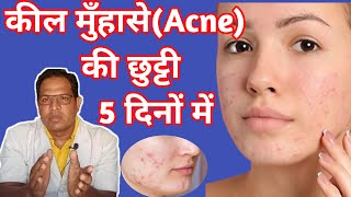 Pimple गायब हो जायंगे  adapalene and clindamycin phosphate gel  Cream For acne and Pimple [upl. by Yerrok122]