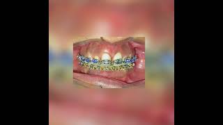 Root Torquing Auxiliary in orthodontics braces orthodontics viral  bracesnfaces [upl. by Lledyr296]