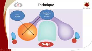 Thyroid Ablation Dr Arun Gupta Department of Interventional Radiology Sir Ganga Ram Hospital [upl. by Rosene]