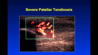 Introduction to Musculoskeletal Ultrasound [upl. by Artemla]