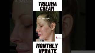 Tri Luma cream Before and After pictures [upl. by Vadim]