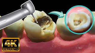 Endodoncia en muela con caries profunda  Tratamiento de conducto [upl. by Desdamonna17]