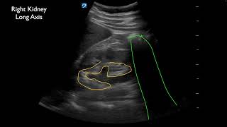 Ureterolithiasis at the Ureterovesical Junction UVJ with Twinkle Artifact [upl. by Kuth]